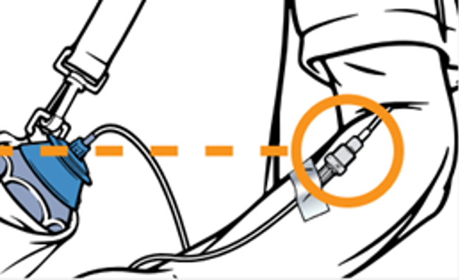 Animatie van de infuusplek op de arm